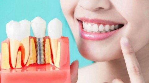 implantaciya-zubov